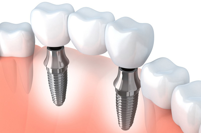 DENTAL-IMPLANTS