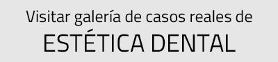 casos reales de estética dental realizados por Clínica dental Cots de Valencia