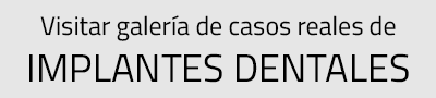 casos reales de implantes dentalesrealizados por Clínica dental Cots de Valencia