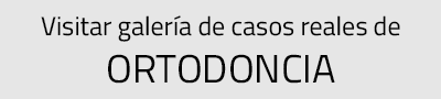 casos reales de ortodoncia realizados por Clínica dental Cots de Valencia