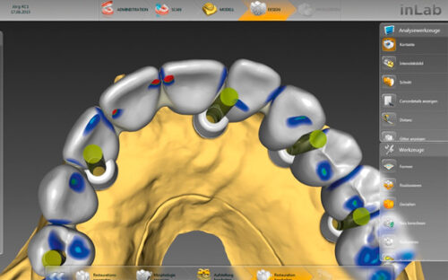 Construccion de superestructuras dentales en Valencia - Clínica dental Cots