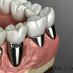 Implantes vs. puentes dentales