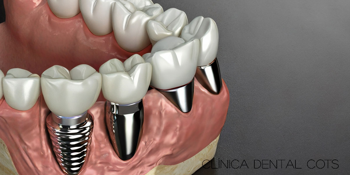 Implantes vs. puentes dentales