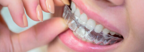 brakets en Valencia - Clínica dental Cots