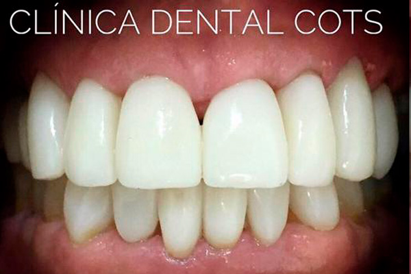 carilla dental Clinica dental Cots Valencia 10b