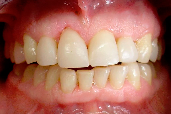 carilla dental Clinica dental Cots Valencia 7b