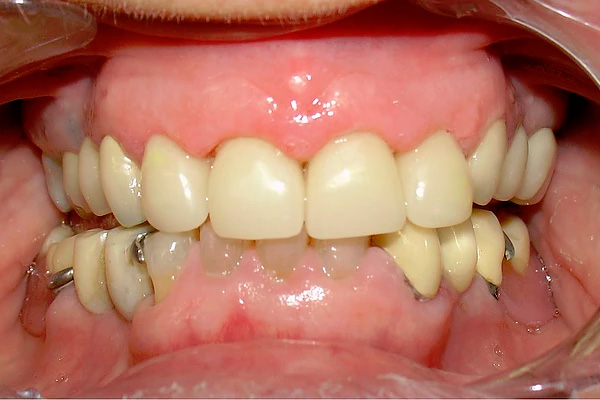 carilla dental Clinica dental Cots Valencia 9b