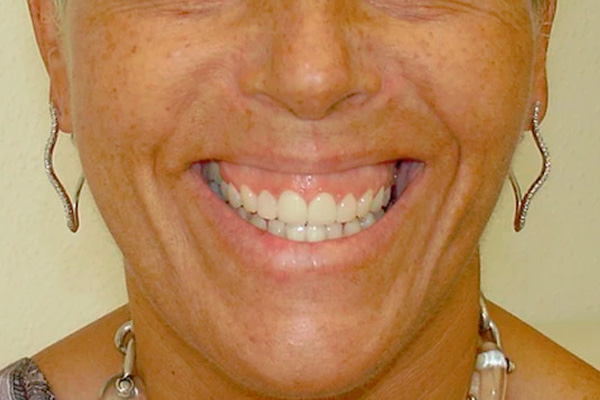 carilla dental Clinica dental Cots Valencia 6b