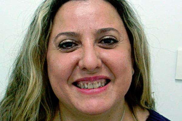 carilla dental Clinica dental Cots Valencia 4a