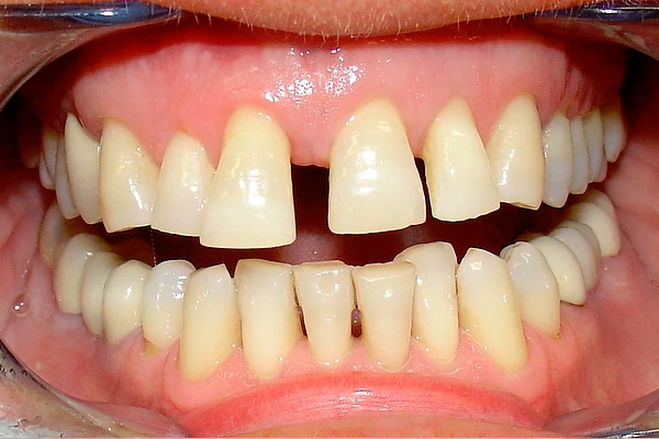 carilla dental Clinica dental Cots Valencia 8a