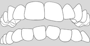 dientes apiñados