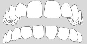 dientes separados