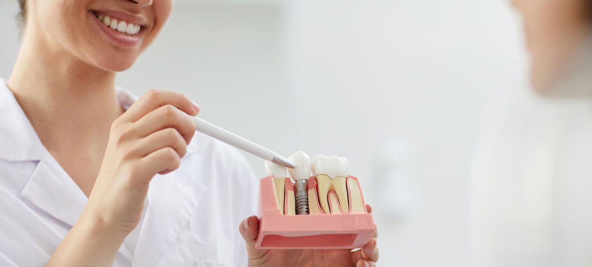 Implantes dentales en Vlancia: Garantía y calidad