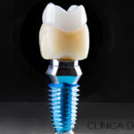 Implantes dentales: Preguntas frecuentes y respuestas clave