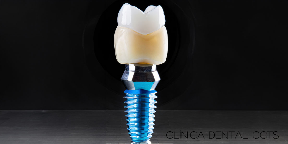 Implantes dentales: Preguntas frecuentes y respuestas clave