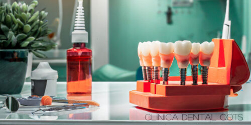 Implantes dentales La solución definitiva para dientes perdidos