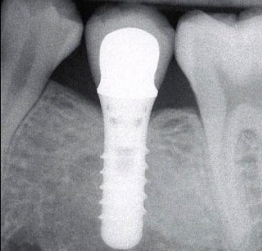 Implantes dentales en Valencia máxima garantía