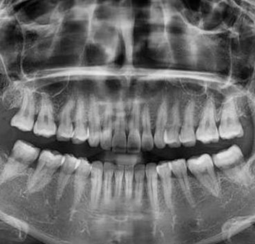 casos de estética dental de Clínica dental Cots