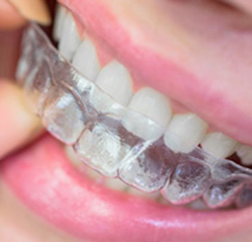 ortodoncia invisible en valencia-Clínica dental Cots