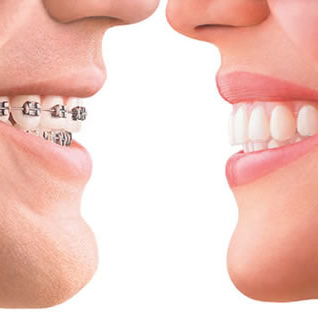 ortodoncia en valencia