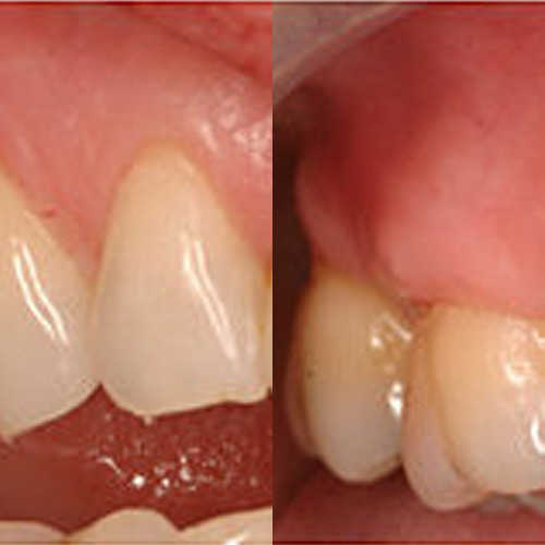 periodoncia en valencia